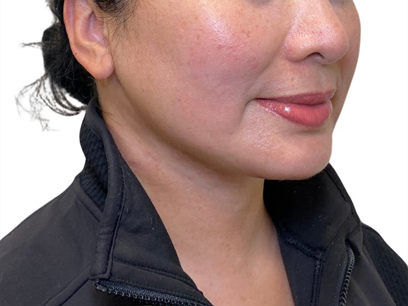 Chin Augmentation Before & After Gallery - Patient 201590 - Image 1