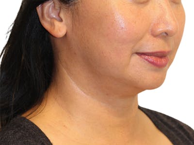 Chin Augmentation Before & After Gallery - Patient 201590 - Image 2