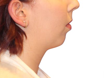 Chin Augmentation Before & After Gallery - Patient 147866 - Image 1