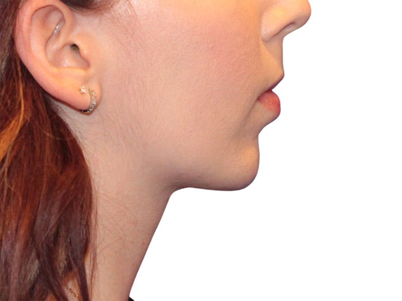 Chin Augmentation Before & After Gallery - Patient 147866 - Image 2