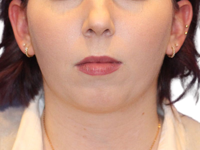 Chin Augmentation Before & After Gallery - Patient 147866 - Image 3