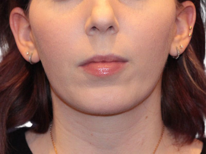 Chin Augmentation Before & After Gallery - Patient 147866 - Image 4
