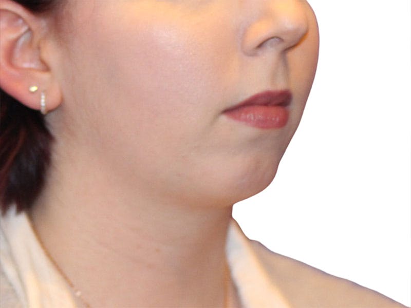 Chin Augmentation Before & After Gallery - Patient 147866 - Image 5