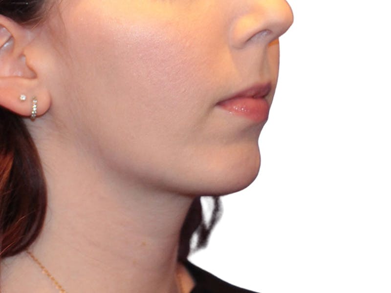 Chin Augmentation Before & After Gallery - Patient 147866 - Image 6