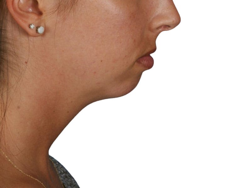 Chin Augmentation Before & After Gallery - Patient 305046 - Image 1