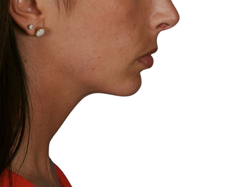 Chin Augmentation Before & After Gallery - Patient 305046 - Image 2