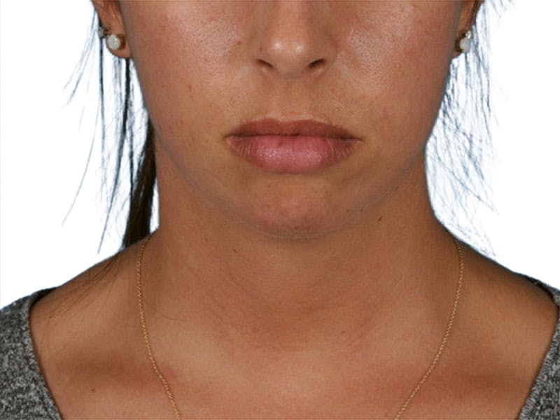 Chin Augmentation Before & After Gallery - Patient 305046 - Image 3