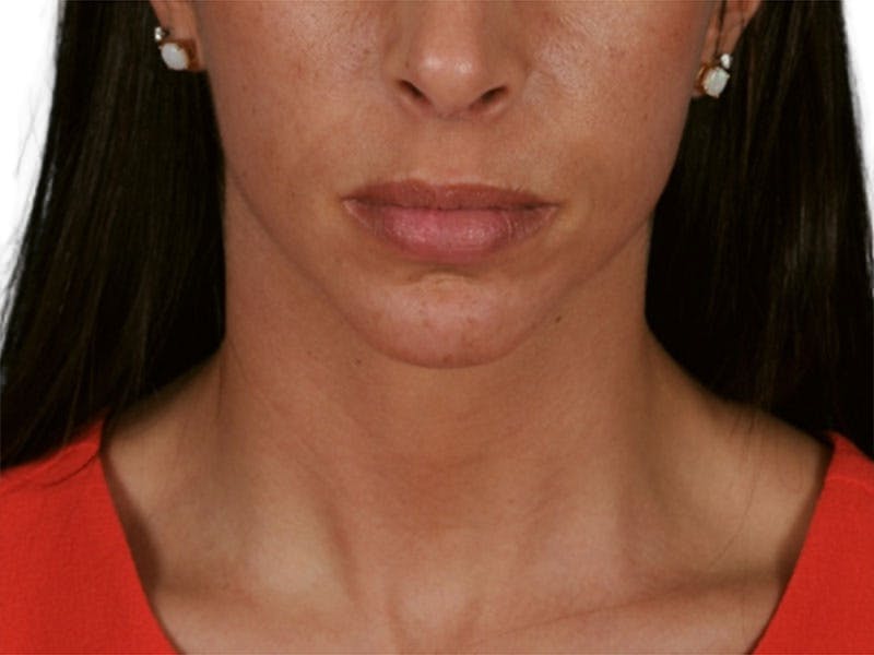 Chin Augmentation Before & After Gallery - Patient 305046 - Image 4