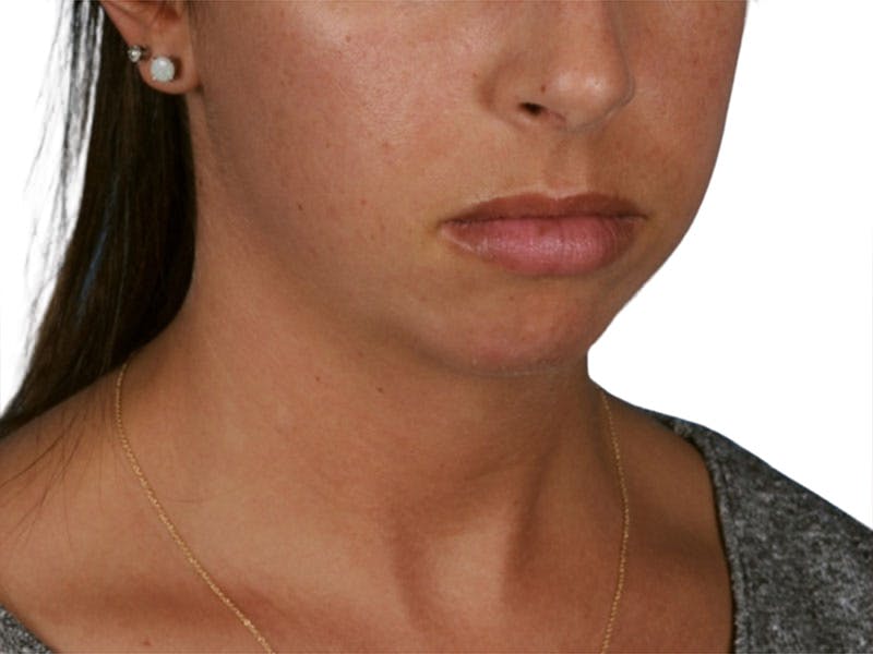 Chin Augmentation Before & After Gallery - Patient 305046 - Image 5