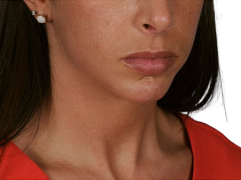 Chin Augmentation Before & After Gallery - Patient 305046 - Image 6