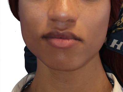 Chin Augmentation Before & After Gallery - Patient 782771 - Image 1