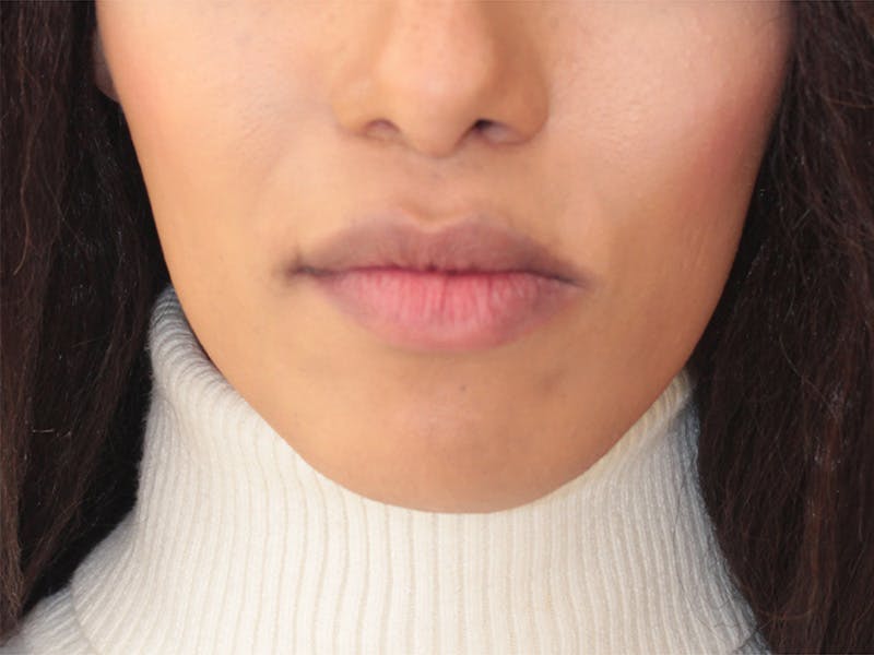 Chin Augmentation Before & After Gallery - Patient 782771 - Image 2