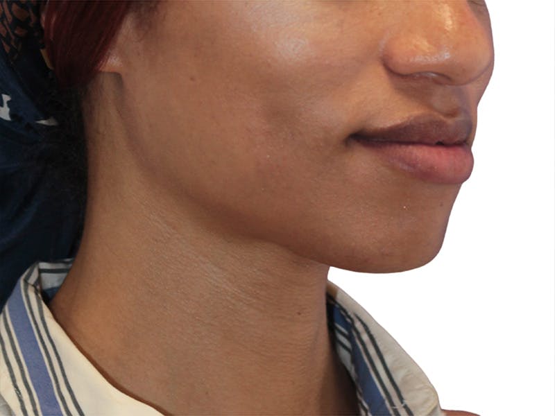 Chin Augmentation Before & After Gallery - Patient 782771 - Image 3