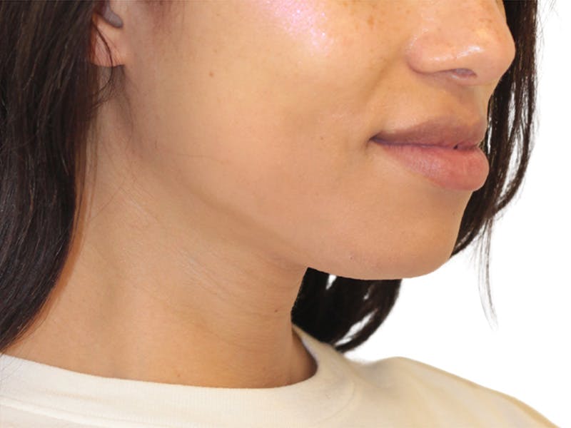 Chin Augmentation Before & After Gallery - Patient 782771 - Image 4