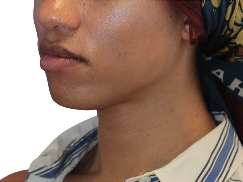Chin Augmentation Before & After Gallery - Patient 782771 - Image 5