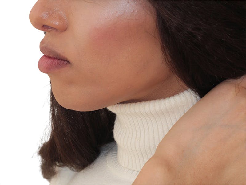 Chin Augmentation Before & After Gallery - Patient 782771 - Image 6