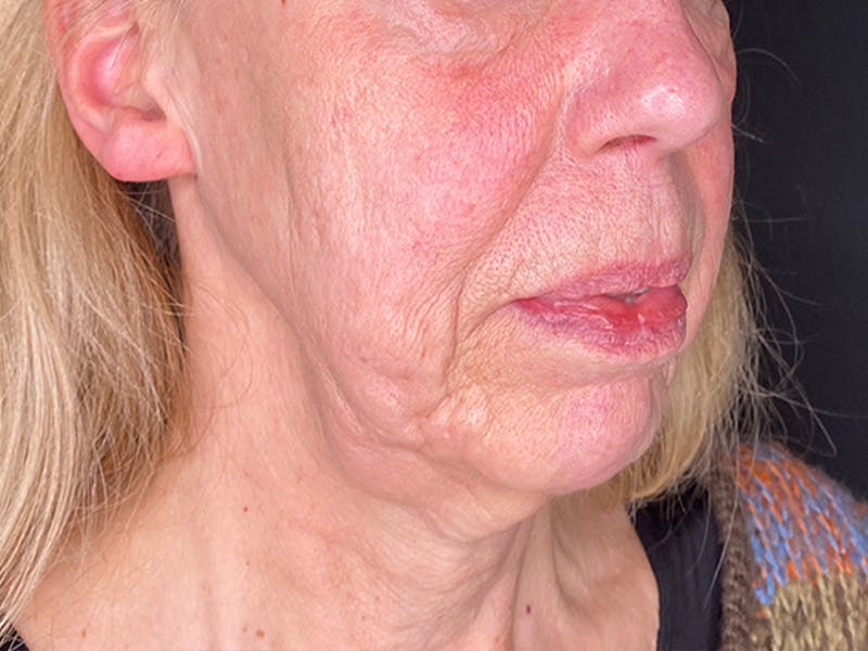 Neck Lift Before & After Gallery - Patient 131845 - Image 1