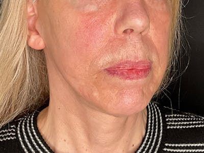 Neck Lift Before & After Gallery - Patient 131845 - Image 2