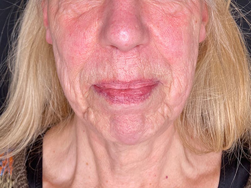 Neck Lift Before & After Gallery - Patient 131845 - Image 3