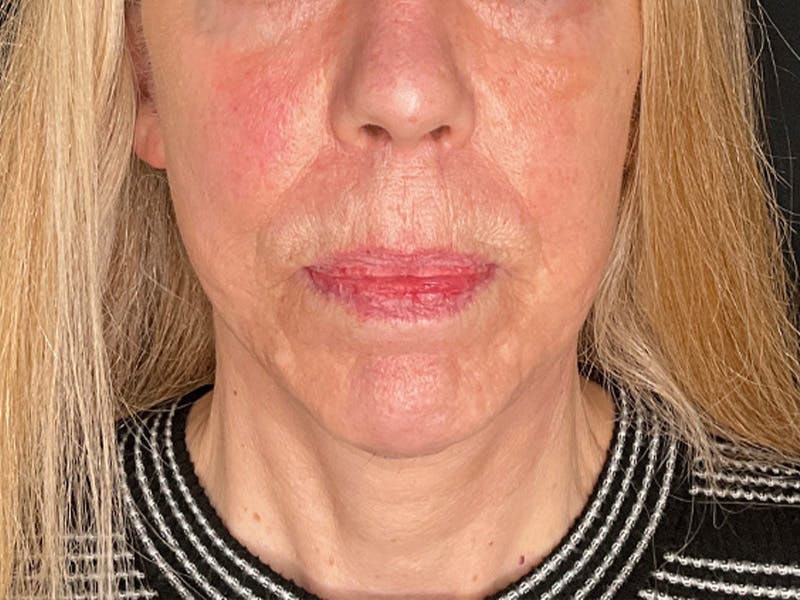 Neck Lift Before & After Gallery - Patient 131845 - Image 4