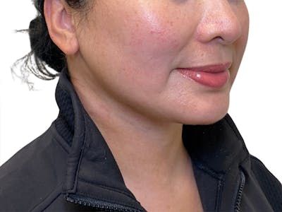 Neck Lift Before & After Gallery - Patient 213077 - Image 2