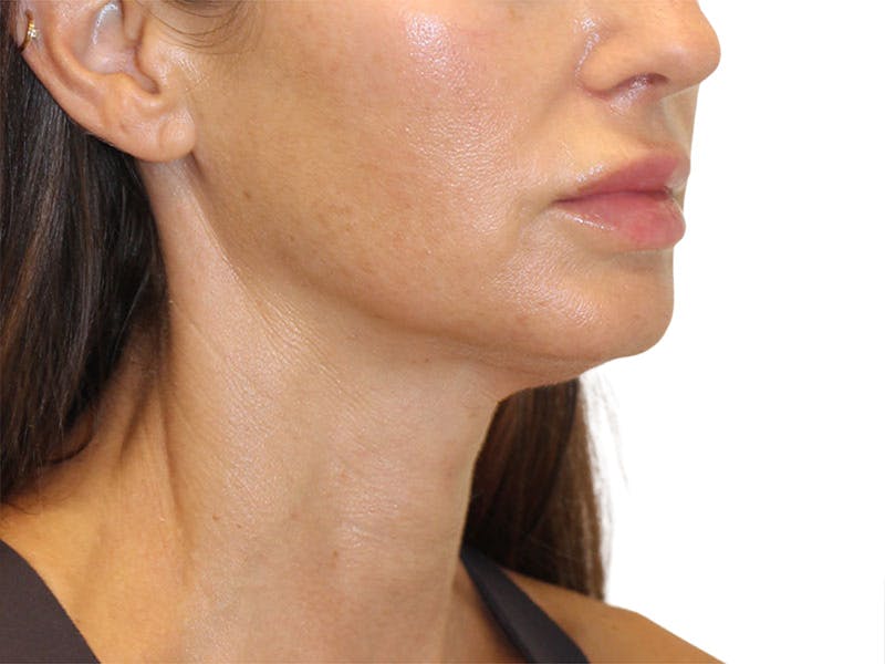 Neck Lift Before & After Gallery - Patient 162615 - Image 1