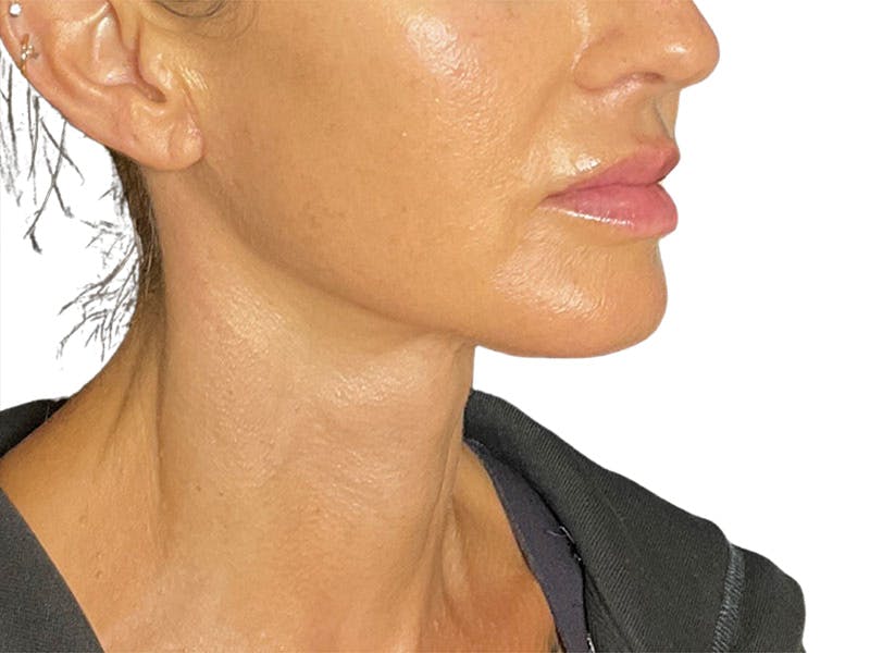 Neck Lift Before & After Gallery - Patient 162615 - Image 2