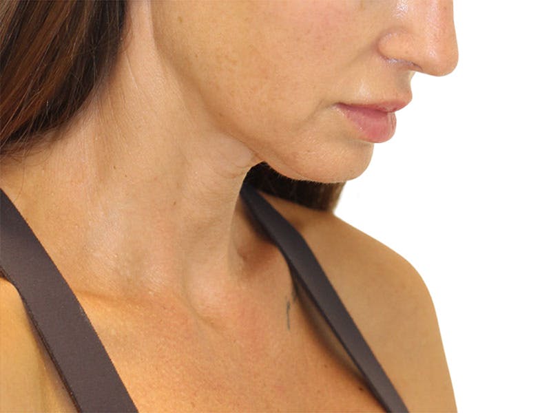 Neck Lift Before & After Gallery - Patient 162615 - Image 3