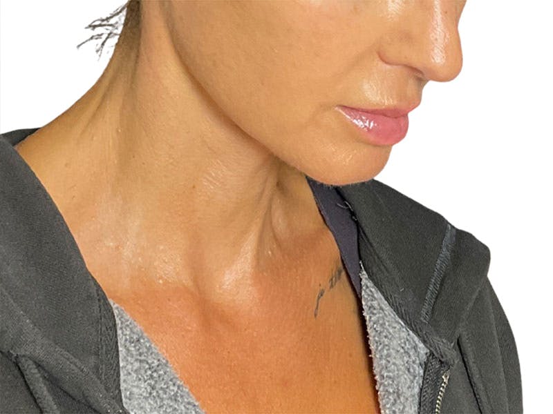 Neck Lift Before & After Gallery - Patient 162615 - Image 4