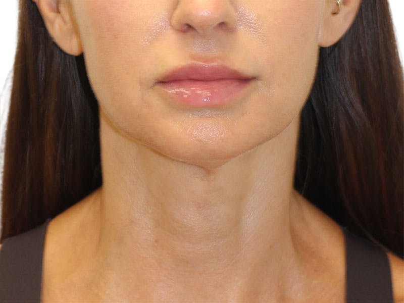 Neck Lift Before & After Gallery - Patient 162615 - Image 5
