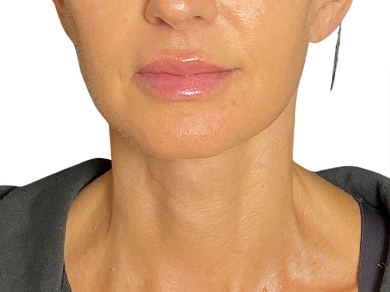 Neck Lift Before & After Gallery - Patient 162615 - Image 6