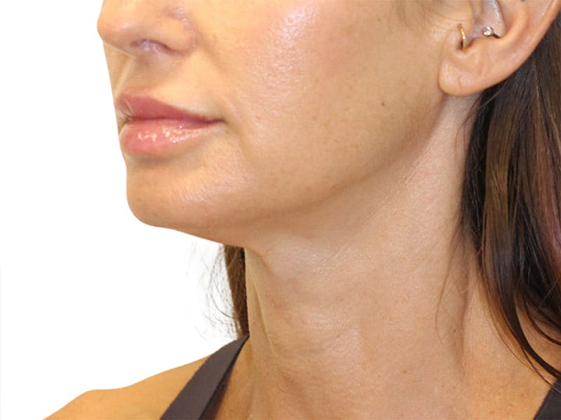 Neck Lift Before & After Gallery - Patient 162615 - Image 7
