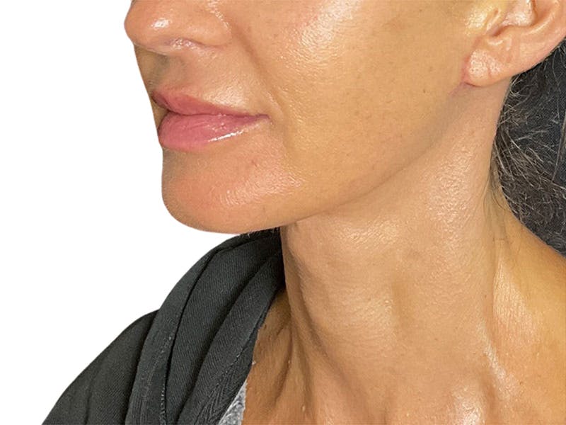 Neck Lift Before & After Gallery - Patient 162615 - Image 8