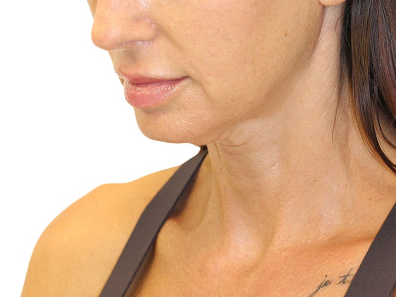 Neck Lift Before & After Gallery - Patient 162615 - Image 9