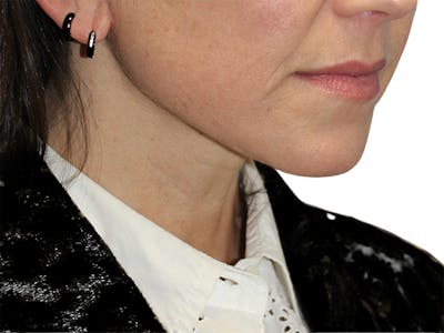 Neck Lift Before & After Gallery - Patient 150006 - Image 2