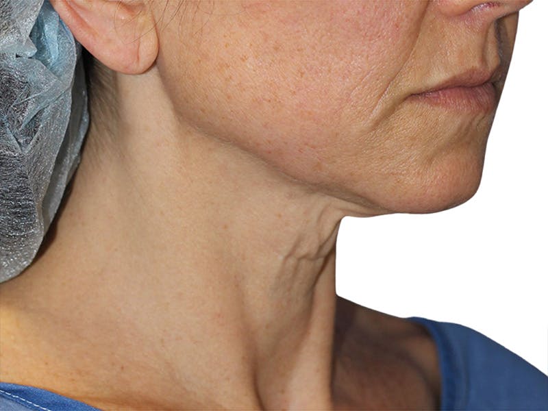 Neck Lift Before & After Gallery - Patient 150006 - Image 3