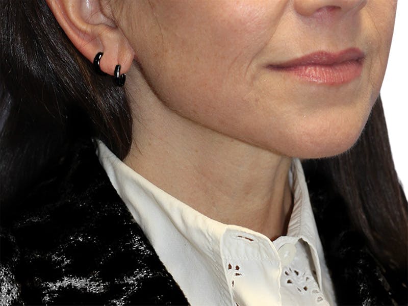 Neck Lift Before & After Gallery - Patient 150006 - Image 4