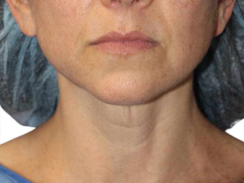 Neck Lift Before & After Gallery - Patient 150006 - Image 5