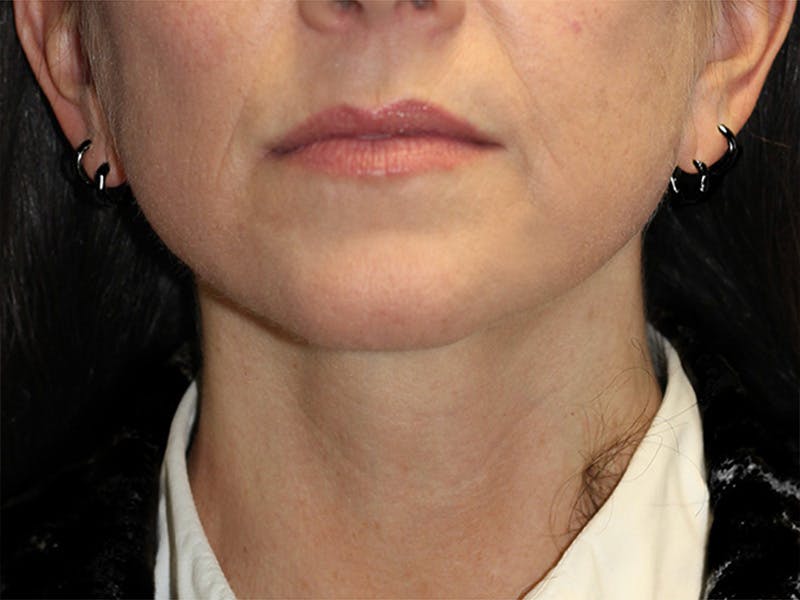 Neck Lift Before & After Gallery - Patient 150006 - Image 6