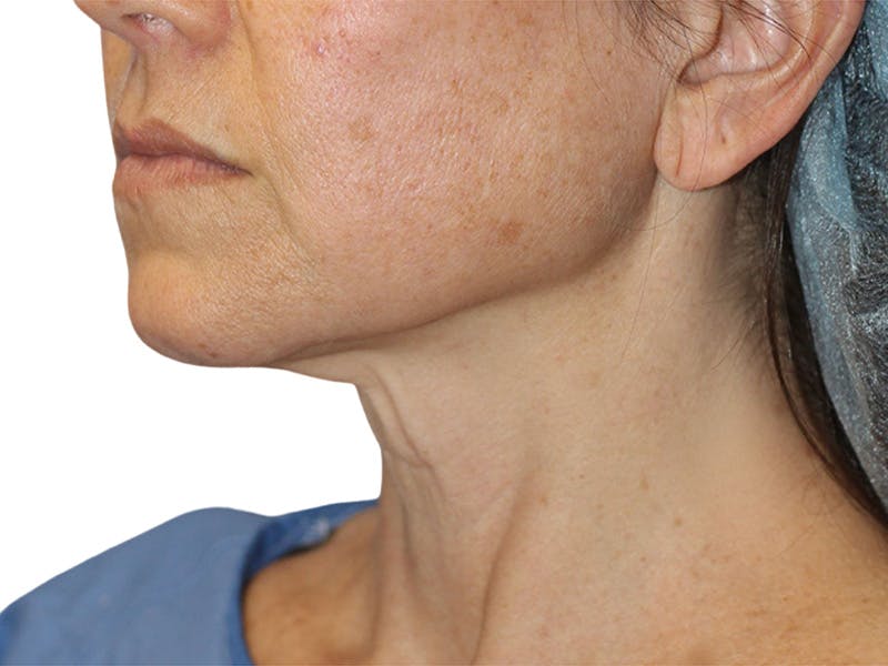 Neck Lift Before & After Gallery - Patient 150006 - Image 7