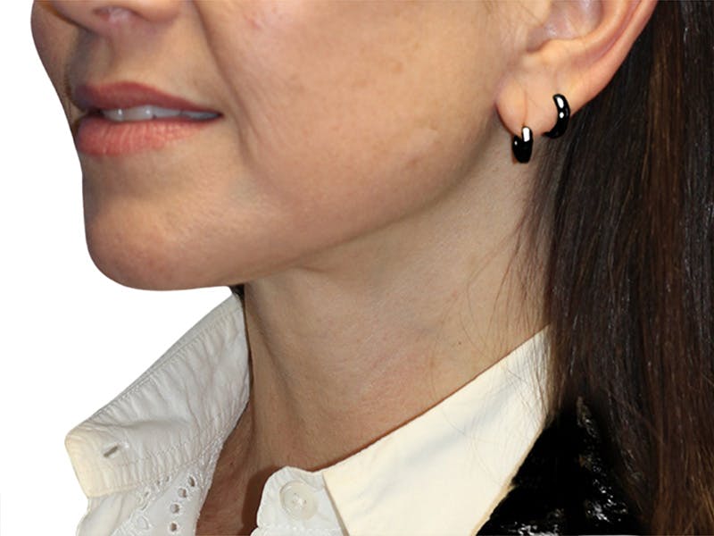 Neck Lift Before & After Gallery - Patient 150006 - Image 8