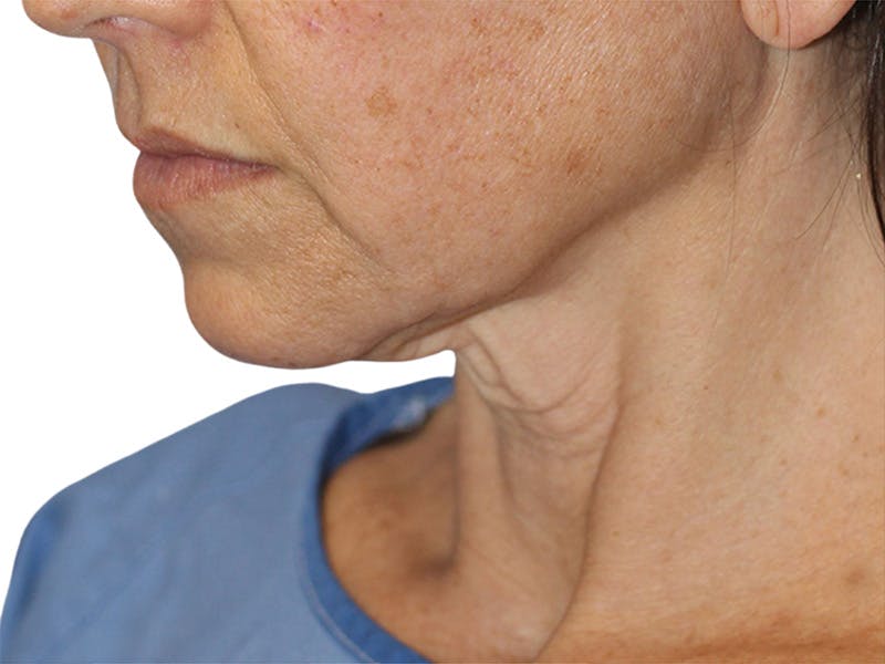 Neck Lift Before & After Gallery - Patient 150006 - Image 9