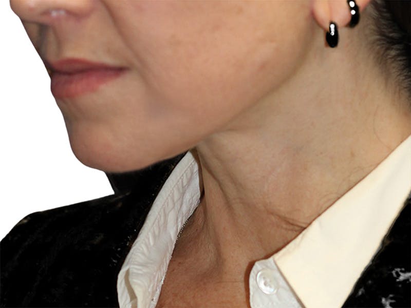 Neck Lift Before & After Gallery - Patient 150006 - Image 10