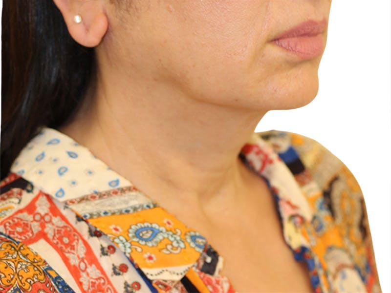 Neck Lift Before & After Gallery - Patient 405716 - Image 1