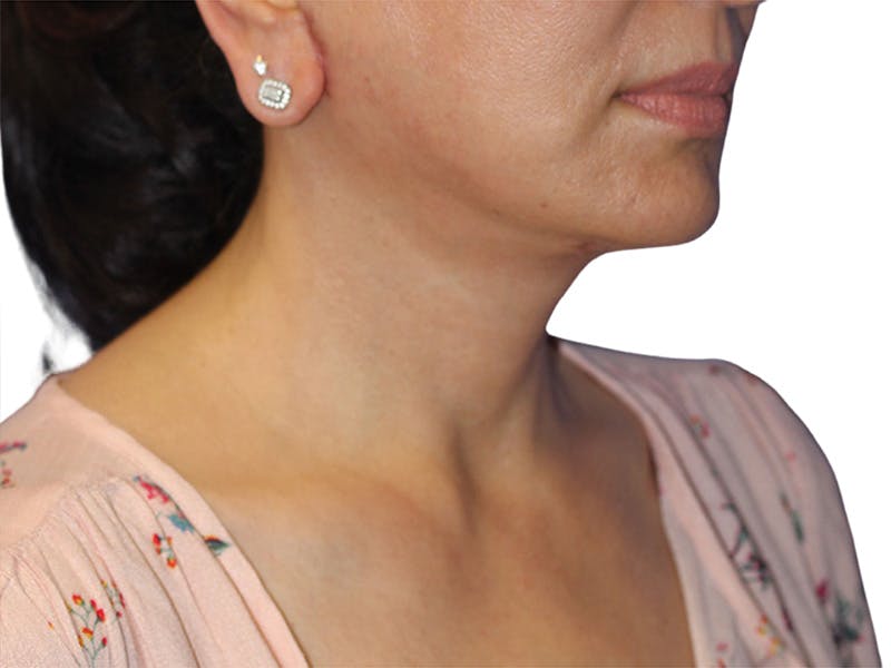 Neck Lift Before & After Gallery - Patient 405716 - Image 2