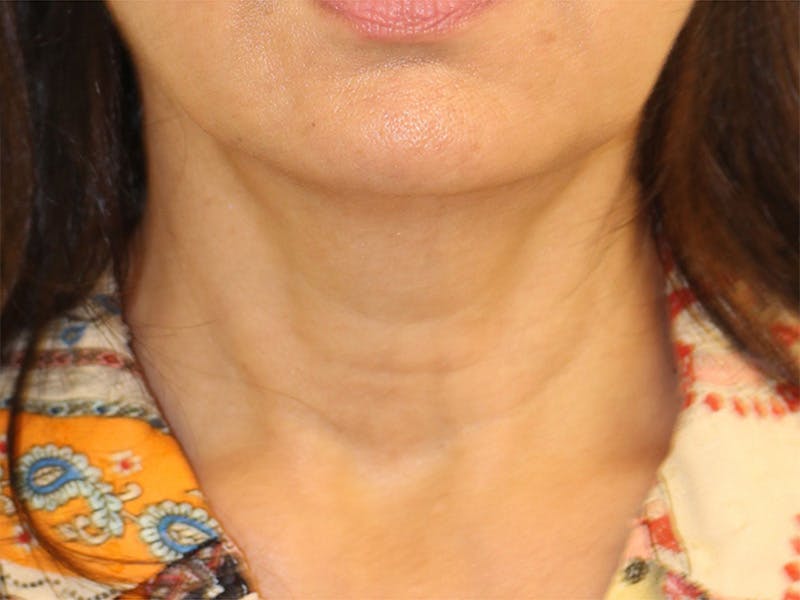 Neck Lift Before & After Gallery - Patient 405716 - Image 3