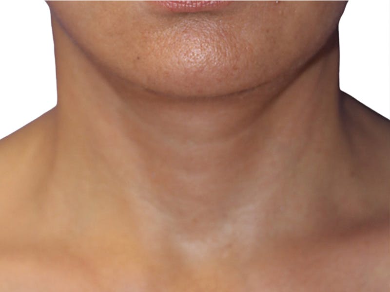 Neck Lift Before & After Gallery - Patient 405716 - Image 4