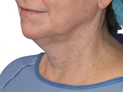Neck Lift Before & After Gallery - Patient 217704 - Image 1