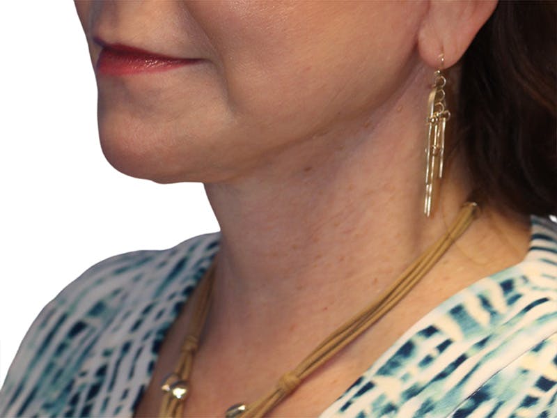 Neck Lift Before & After Gallery - Patient 217704 - Image 2