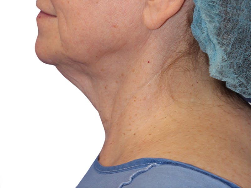 Neck Lift Before & After Gallery - Patient 217704 - Image 3